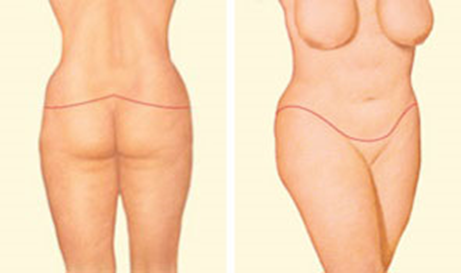 Body Lift Closure